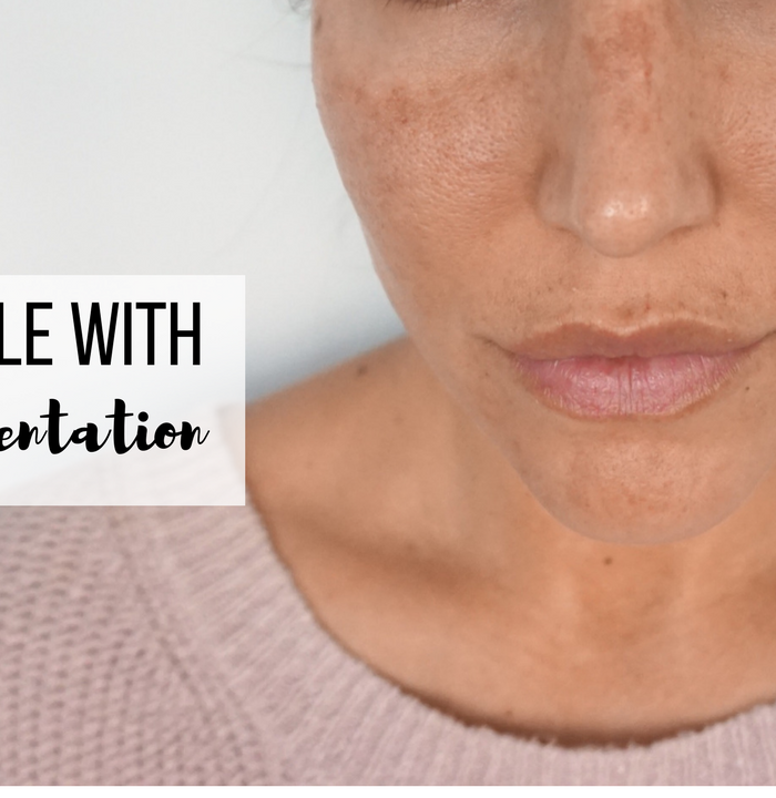 Before & After: Laser Treatments For Hyperpigmentation
